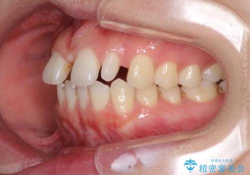 欠損歯と矮小歯 矯正治療と前歯のセラミック治療の治療前