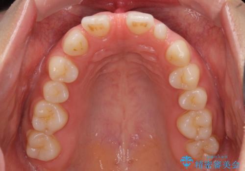 欠損歯と矮小歯 矯正治療と前歯のセラミック治療の治療前