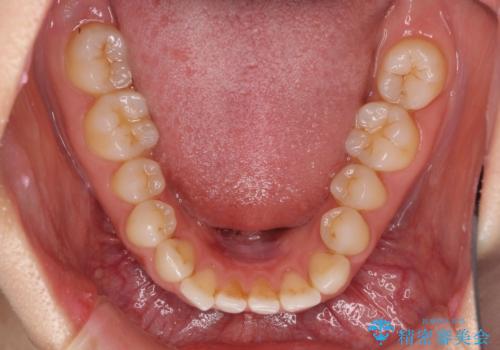 欠損歯と矮小歯 矯正治療と前歯のセラミック治療の治療前