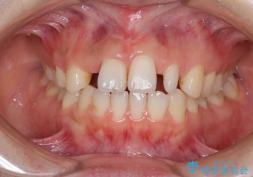 欠損歯と矮小歯 矯正治療と前歯のセラミック治療の治療中