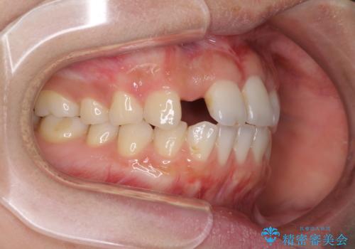 欠損歯と矮小歯　矯正治療と前歯のセラミック治療の治療中