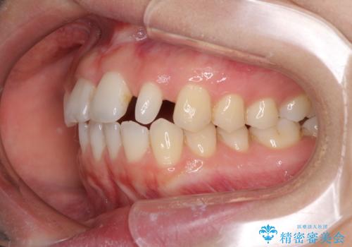 欠損歯と矮小歯 矯正治療と前歯のセラミック治療の治療中