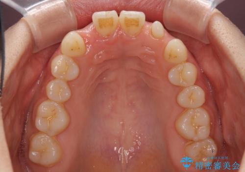欠損歯と矮小歯 矯正治療と前歯のセラミック治療の治療中