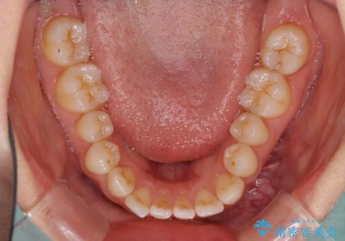 欠損歯と矮小歯 矯正治療と前歯のセラミック治療の治療中