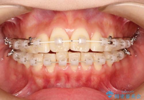 前歯で咬めない・出っ歯　抜歯矯正で整った上下の前歯への治療中
