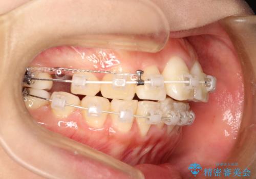 前歯で咬めない・出っ歯 抜歯矯正で整った上下の前歯への治療中