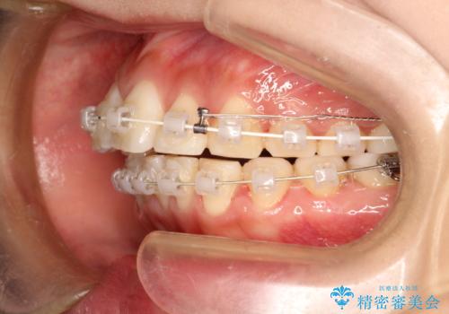 前歯で咬めない・出っ歯 抜歯矯正で整った上下の前歯への治療中