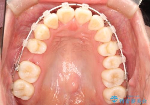 前歯で咬めない・出っ歯　抜歯矯正で整った上下の前歯への治療中