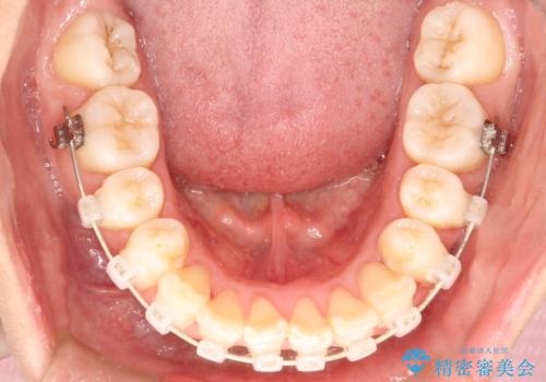 前歯で咬めない・出っ歯 抜歯矯正で整った上下の前歯への治療中
