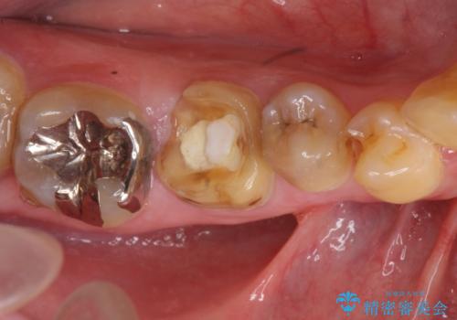 つめものが取れたのを放置 神経の治療からやりかえの治療前