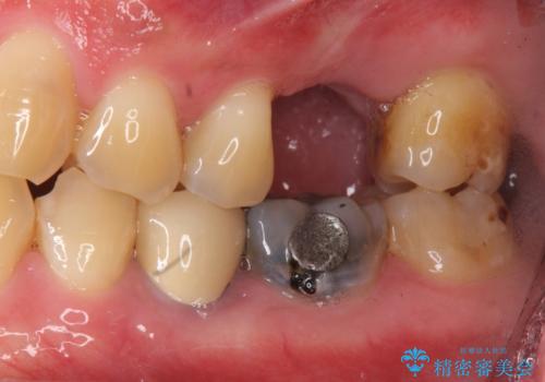 上の奥歯のインプラント、全体的な虫歯治療の症例 治療前