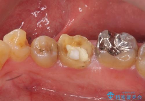 つめものが取れたのを放置 神経の治療からやりかえの症例 治療前