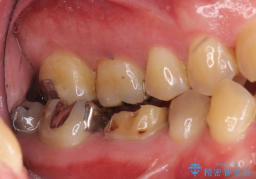 つめものが取れたのを放置 神経の治療からやりかえの治療前