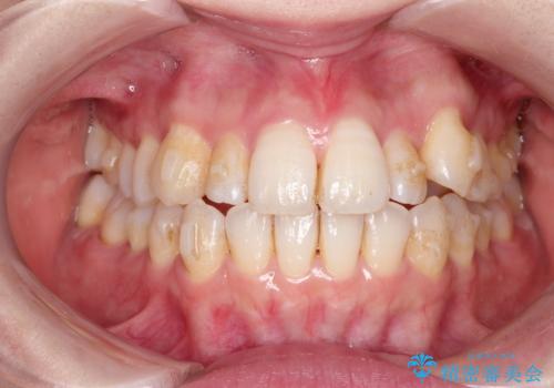 インビザラインで八重歯の矯正の治療中