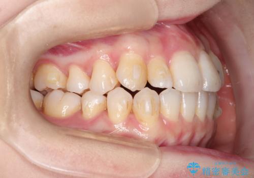 インビザラインで八重歯の矯正の治療中