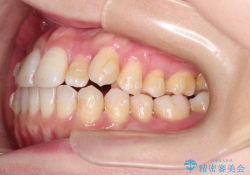 インビザラインで八重歯の矯正の治療中