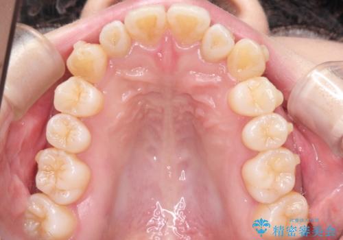 インビザラインで八重歯の矯正の治療中