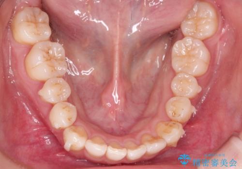 インビザラインで八重歯の矯正の治療中