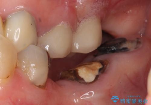 どうしても抜歯したくない　歯根分割術・骨外科手術で歯を残す　50代女性の治療前