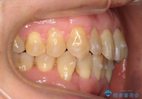 前歯のがたつき インビザラインで抜歯矯正の治療中
