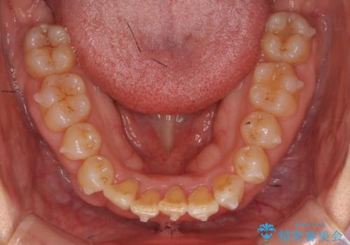 前歯のがたつき　インビザラインで抜歯矯正の治療中