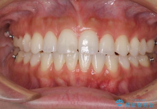 前歯のオープンバイトを治したい インビザラインでの矯正治療の治療中