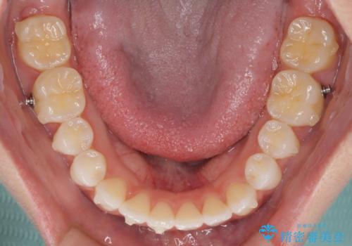 前歯のオープンバイトを治したい インビザラインでの矯正治療の治療中