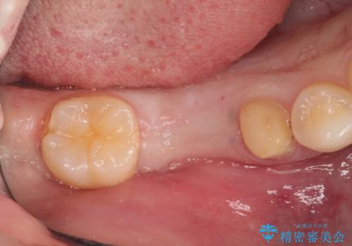 保存不可能な歯を抜歯してインプラント治療の治療中