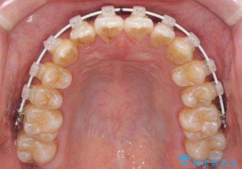 下顎前歯と上顎の部分矯正の治療中