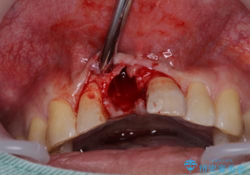 折れてしまった前歯 インプラントによる補綴治療の治療中