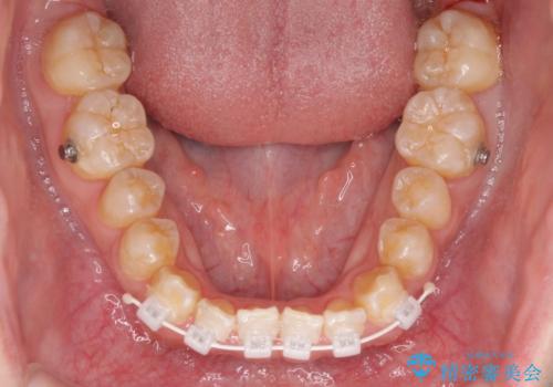下顎前歯と上顎の部分矯正の治療中