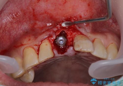 折れてしまった前歯 インプラントによる補綴治療の治療後