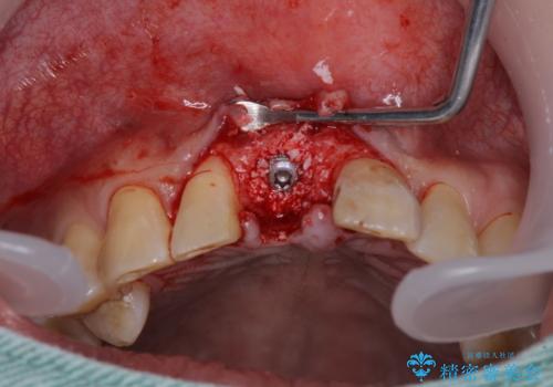 折れてしまった前歯 インプラントによる補綴治療の治療前