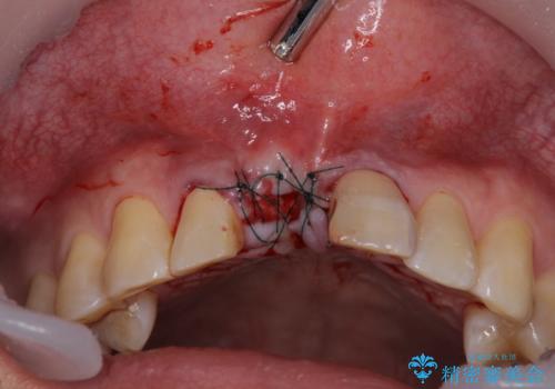 折れてしまった前歯 インプラントによる補綴治療の治療中
