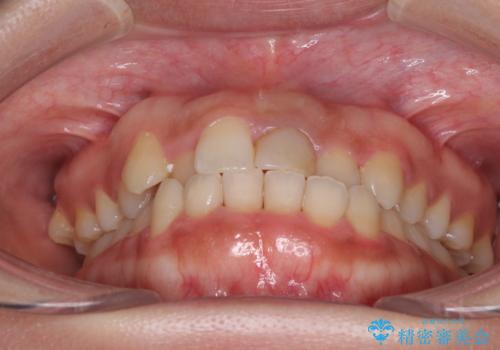 前歯のクロスバイトと変色した歯　ワイヤー矯正とセラミック治療の治療前