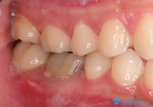 保存不可能な歯を抜歯してインプラント治療の症例 治療前