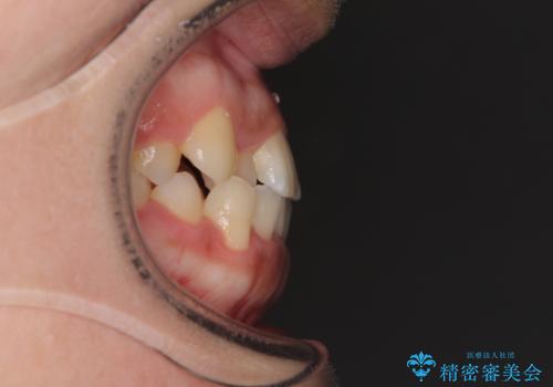 前歯のクロスバイトと変色した歯 ワイヤー矯正とセラミック治療の治療前