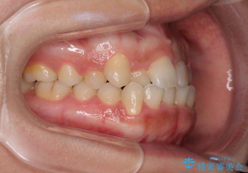 前歯のクロスバイトと変色した歯 ワイヤー矯正とセラミック治療の治療前
