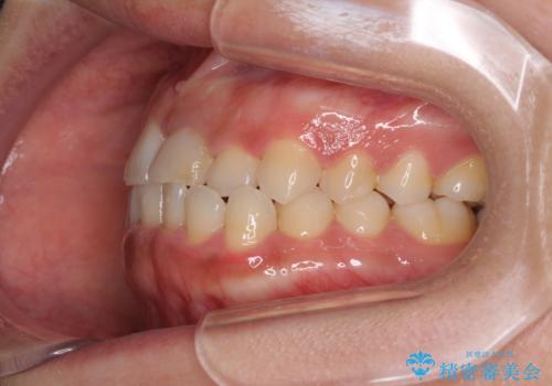 前歯のクロスバイトと変色した歯　ワイヤー矯正とセラミック治療の治療前