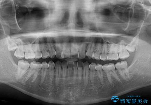 前歯のクロスバイト メタル装置での矯正治療の治療前