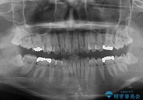 深い咬み合わせと奥歯のむし歯 総合歯科治療の治療前
