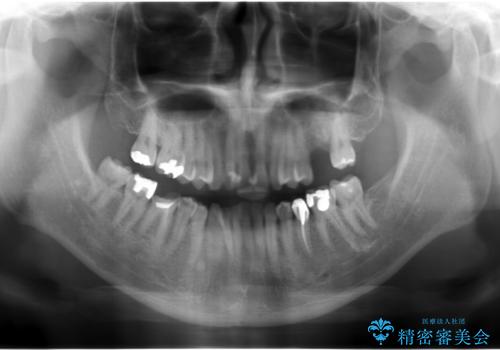 上の奥歯のインプラント、全体的な虫歯治療の治療前