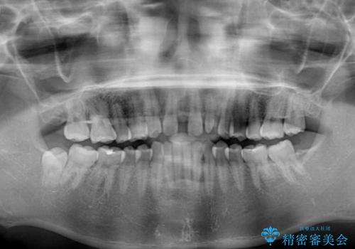 欠損歯と矮小歯 矯正治療と前歯のセラミック治療の治療前