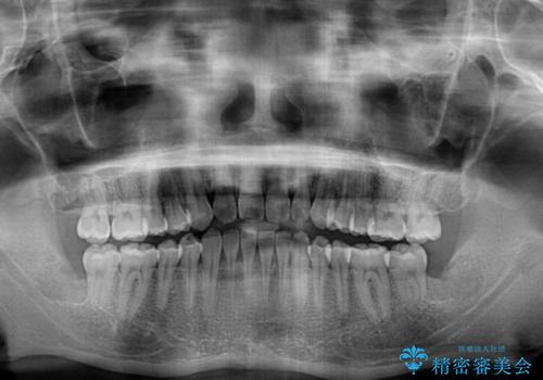 下顎前歯と上顎の部分矯正の治療後