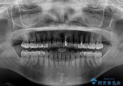 前歯のクロスバイトと変色した歯 ワイヤー矯正とセラミック治療の治療後