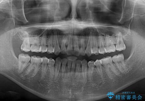 前歯のクロスバイト メタル装置での矯正治療の治療後