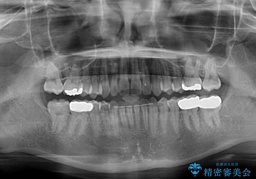 深い咬み合わせと奥歯のむし歯 総合歯科治療の治療後