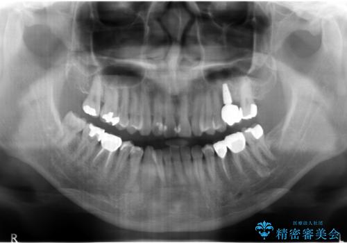 上の奥歯のインプラント、全体的な虫歯治療の治療後