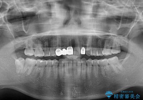 欠損歯と矮小歯 矯正治療と前歯のセラミック治療の治療後