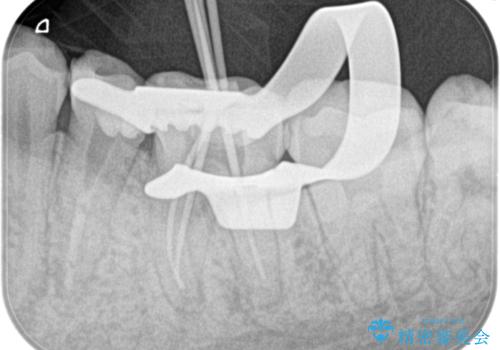 精密根管治療。大臼歯イニシャルケースの治療中